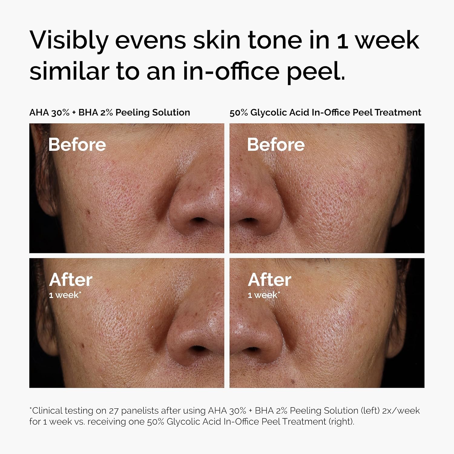 The Ordinary AHA 30% + BHA 2% Peeling Solution, Advanced Exfoliating Peel for Brighter Skin - Image 6