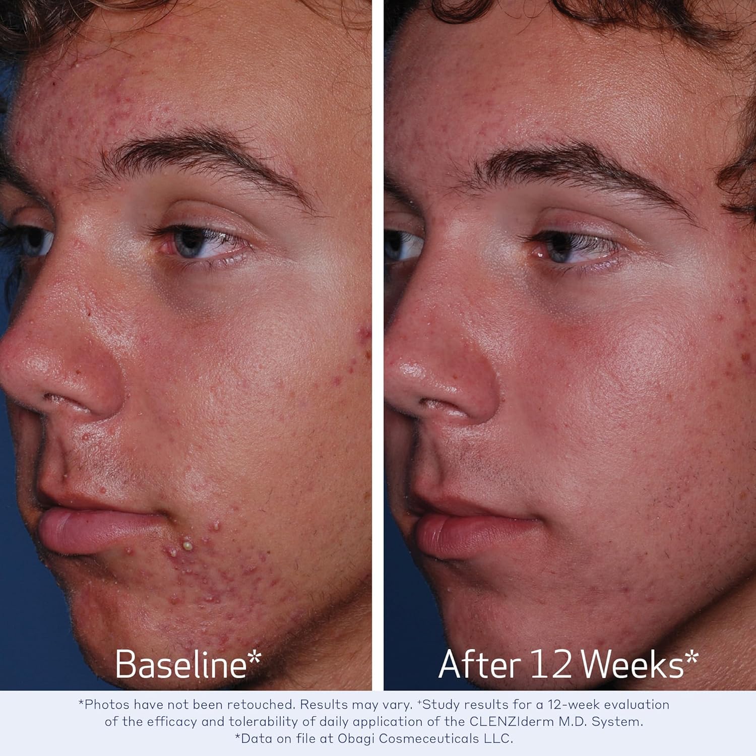 Obagi Medical CLENZIderm M.D. Pore Therapy Acne Treatment - Image 5