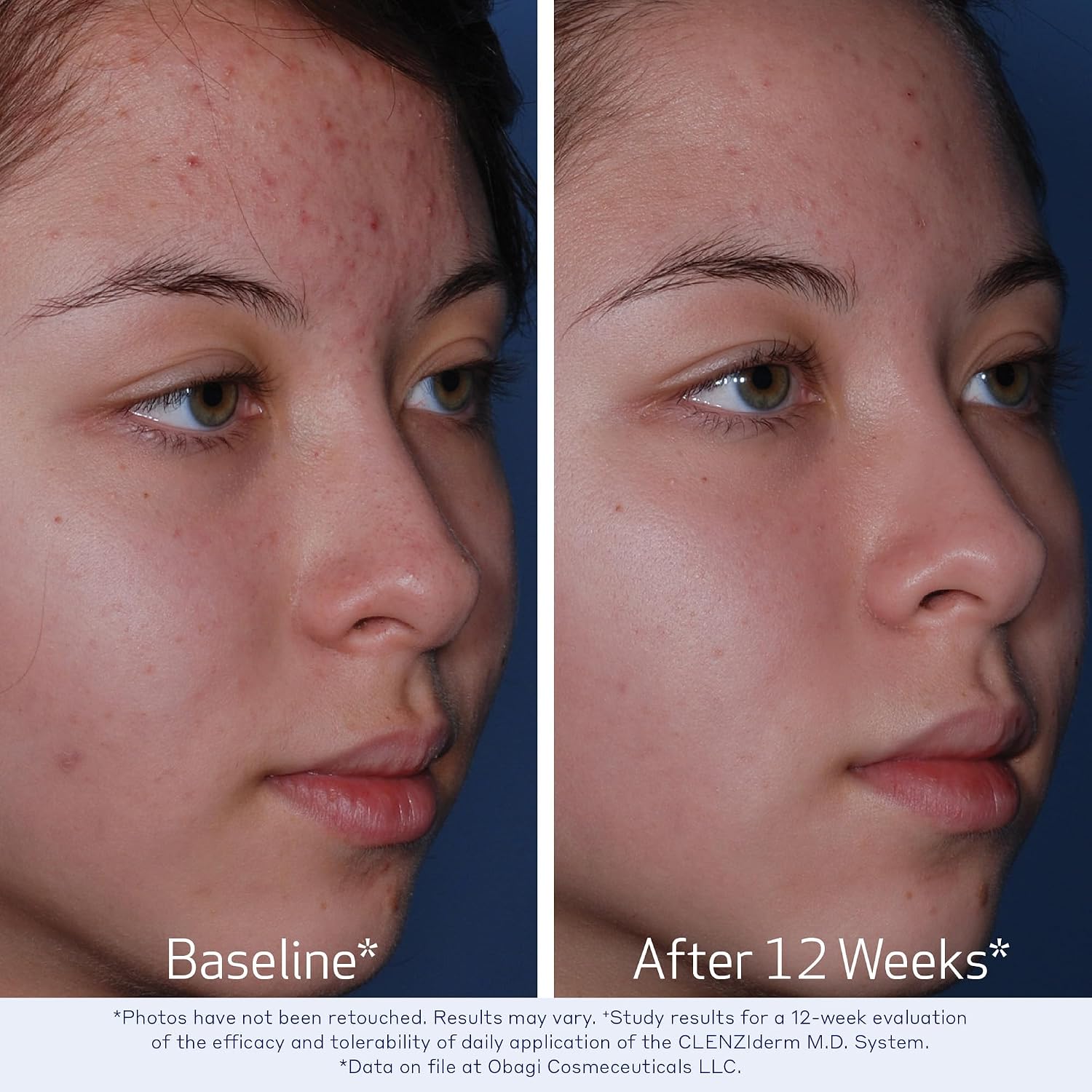 Obagi Medical CLENZIderm M.D. Pore Therapy Acne Treatment - Image 4