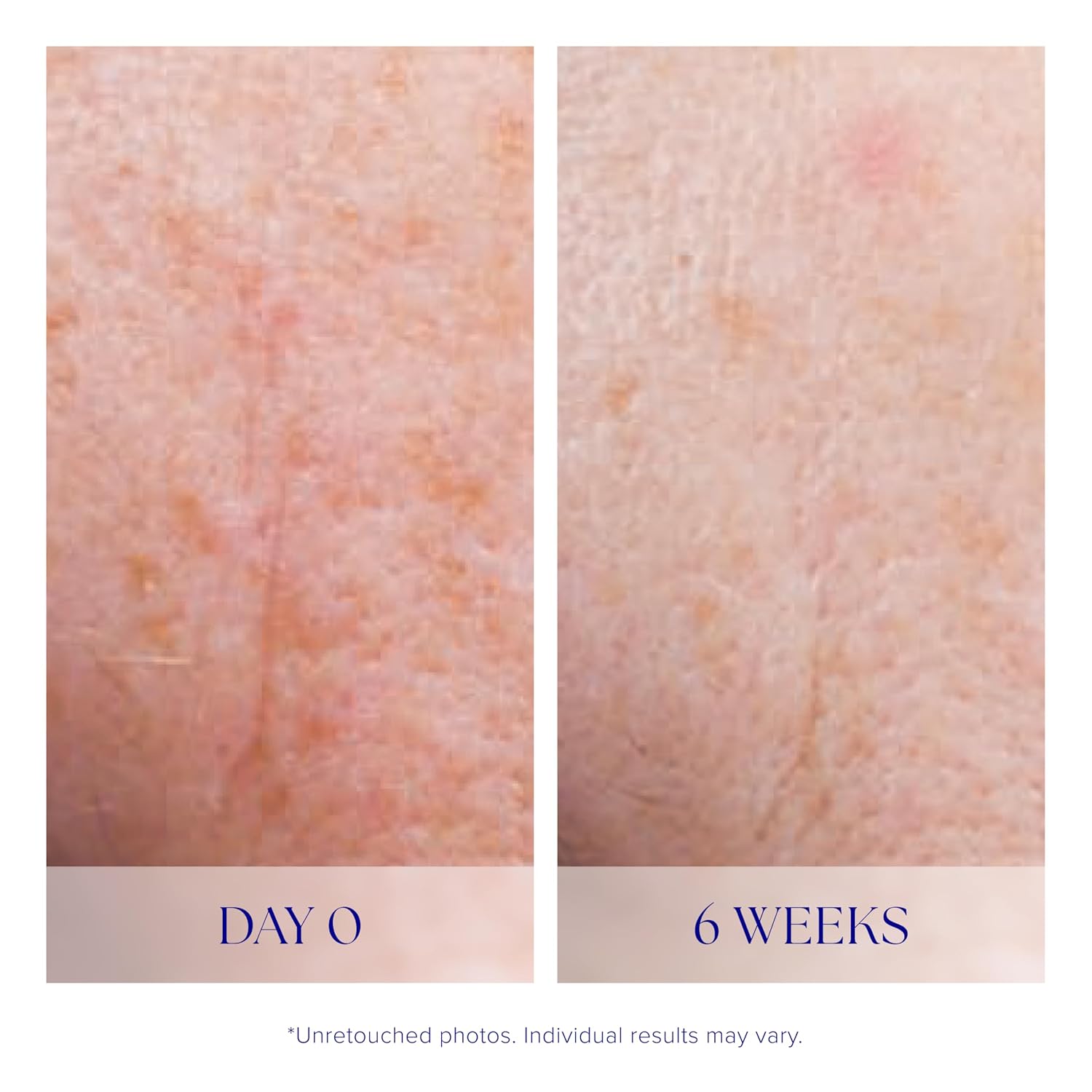 iS CLINICAL Active Serum, Helps visibly even skin tone, Excellent for acne-prone skin, Anti-Aging, Face Serum - Image 6